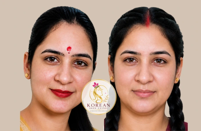 Skin Brightening Treatment Before and After Results for Uneven Skin Tone in Raebareli