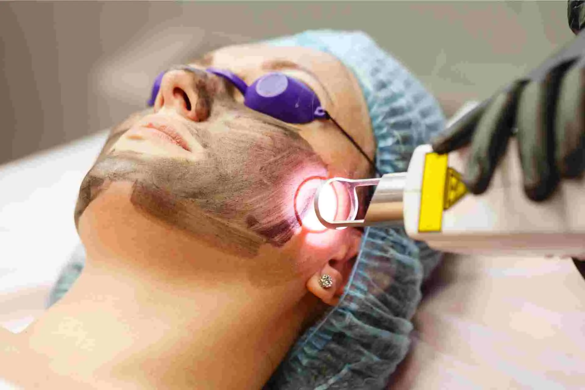 Hollywood Carbon Laser Facial for Glowing and Rejuvenated Skin in Raebareli